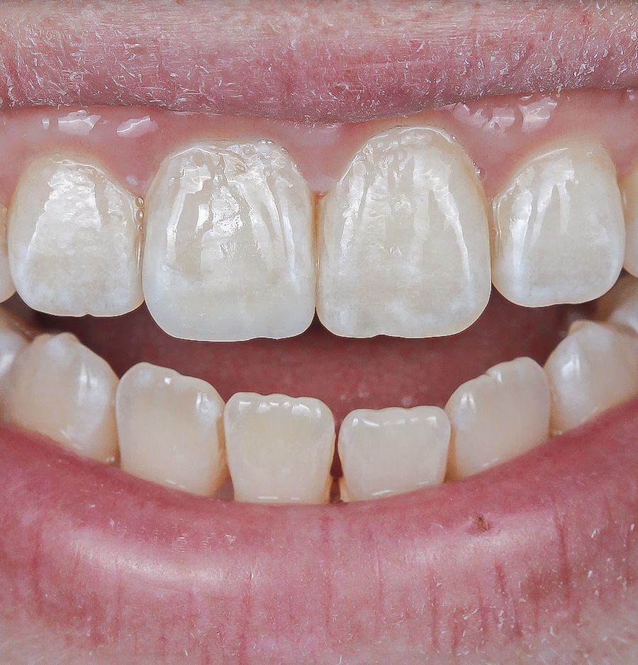 Chipped tooth repair After